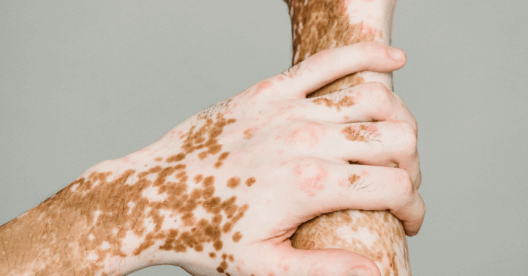 autoimmune care PCT
