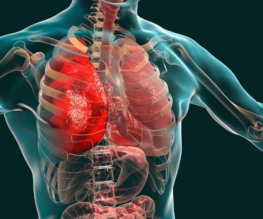 Pulmonary-Conditions-PCT-Panama Banner Image displaying Pulmonary conditions developing in human body.