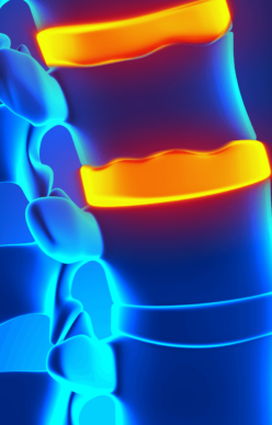 Spinal-Arthritis-Therapy-Advancements Illustrative image showing Spinal arthritis issues in human body.